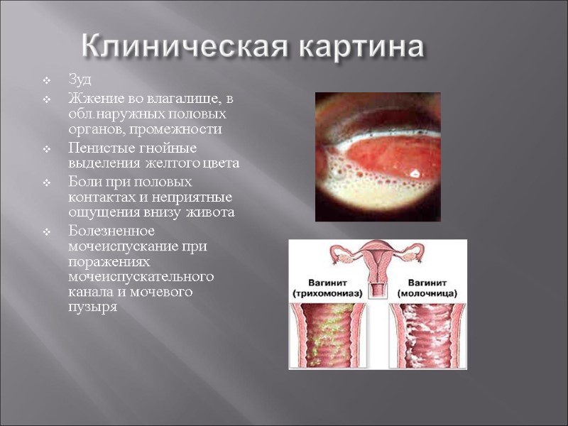 Клиническая картина Зуд Жжение во влагалище, в обл.наружных половых органов, промежности Пенистые гнойные выделения